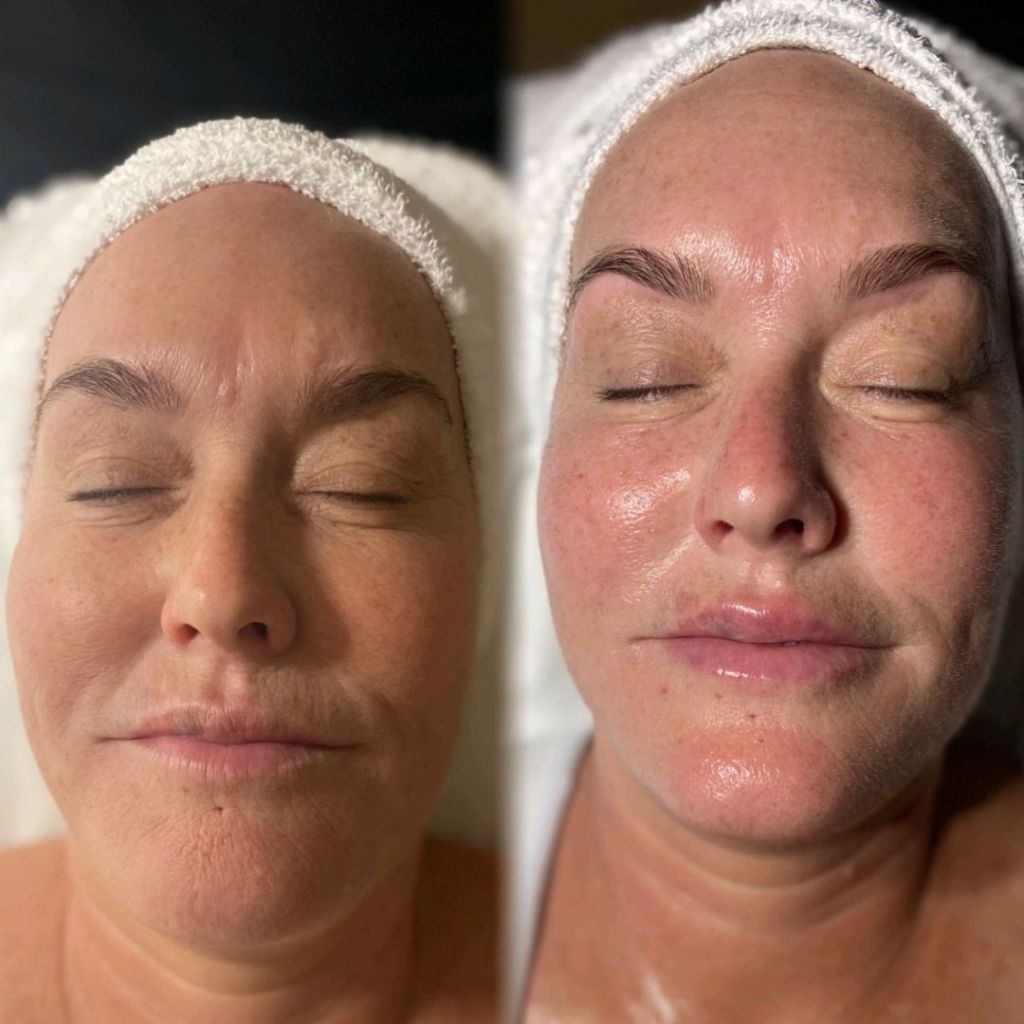 Hot! Mama Gourmet Facial at VERABELLA - Before & After
