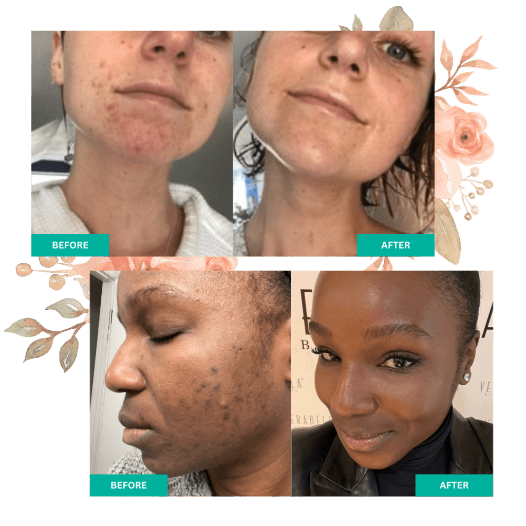 Before and After Acne