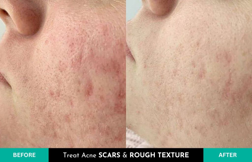 BioRePeelCl3 to treat acne scars and rough texture - VERABELLA Skin Therapy Spa