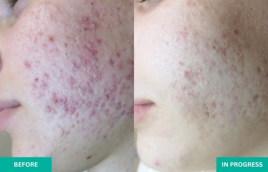 Severe Acne Treatment in Los Angeles - VERABELLA