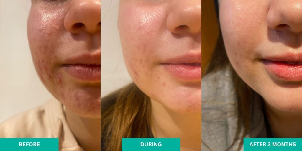 VERABELLA Acne Treatment Before & After 3 Months