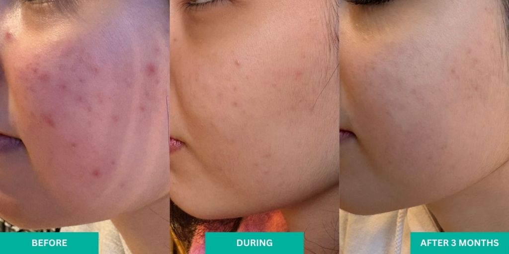 VERABELLA Acne Results After 3 Months