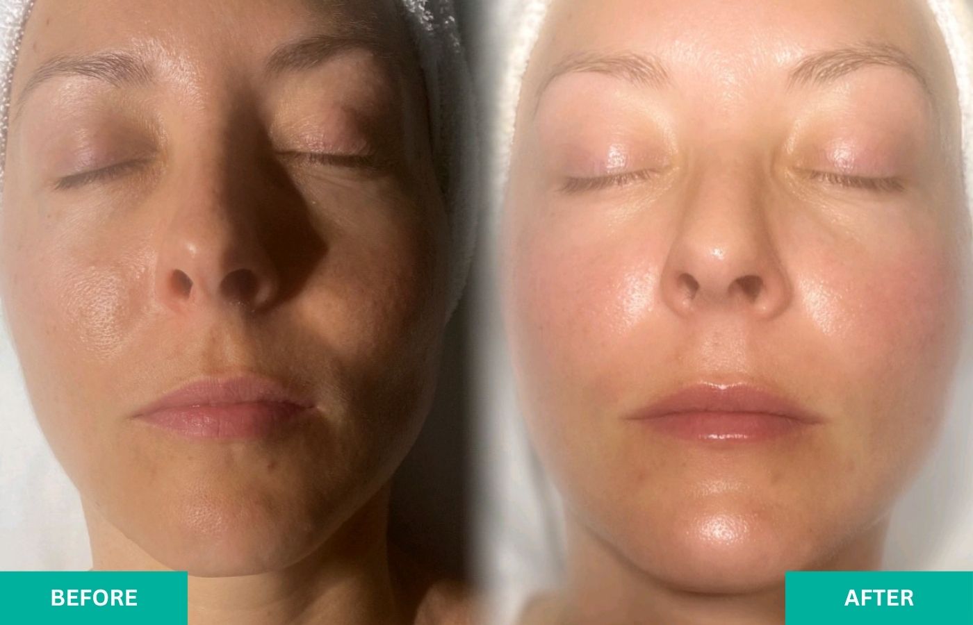 Facial